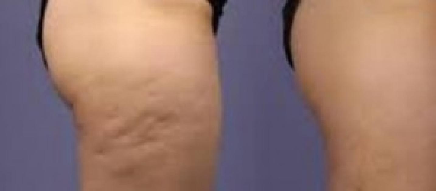come eliminare la cellulite dovuta alla pillola