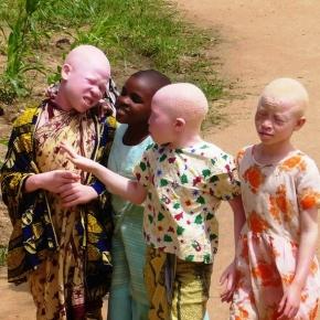 Albinos da Tanzânia são discriminados
