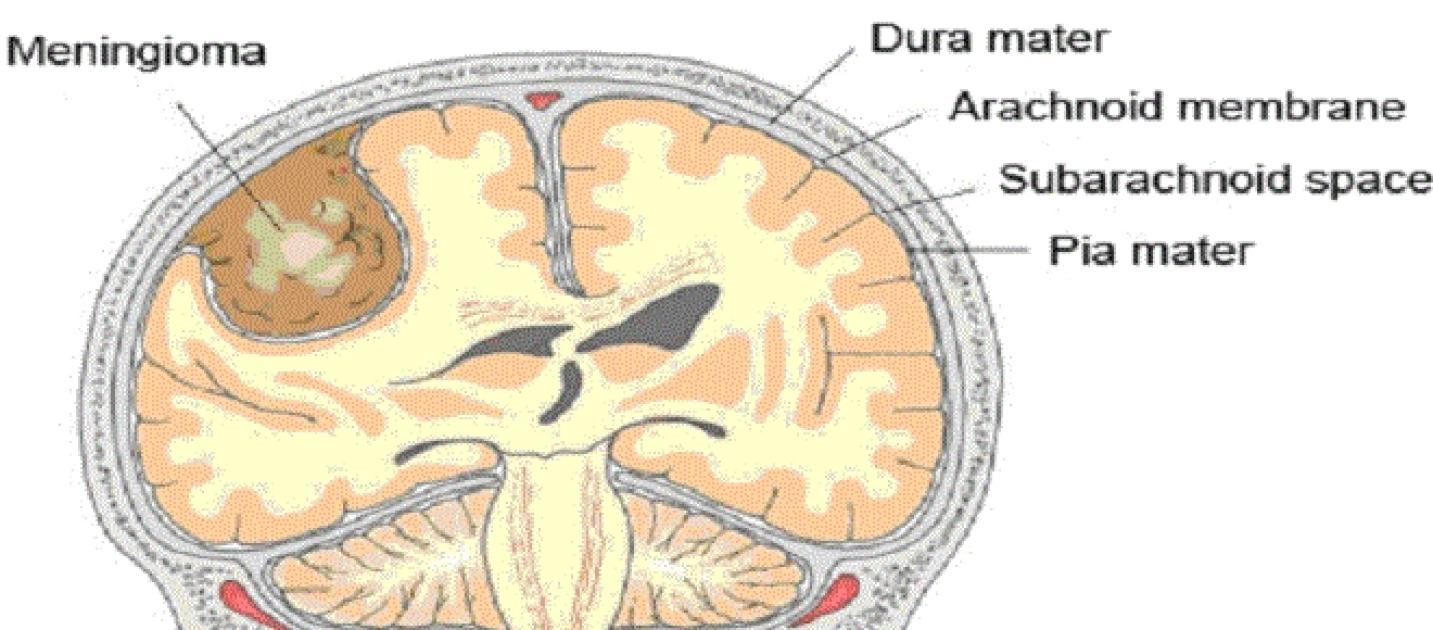 Meningioma e tumori cerebrali benigni il progresso offre alternative