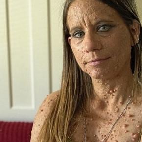 Imagem da mulher com o corpo cheio de caroços