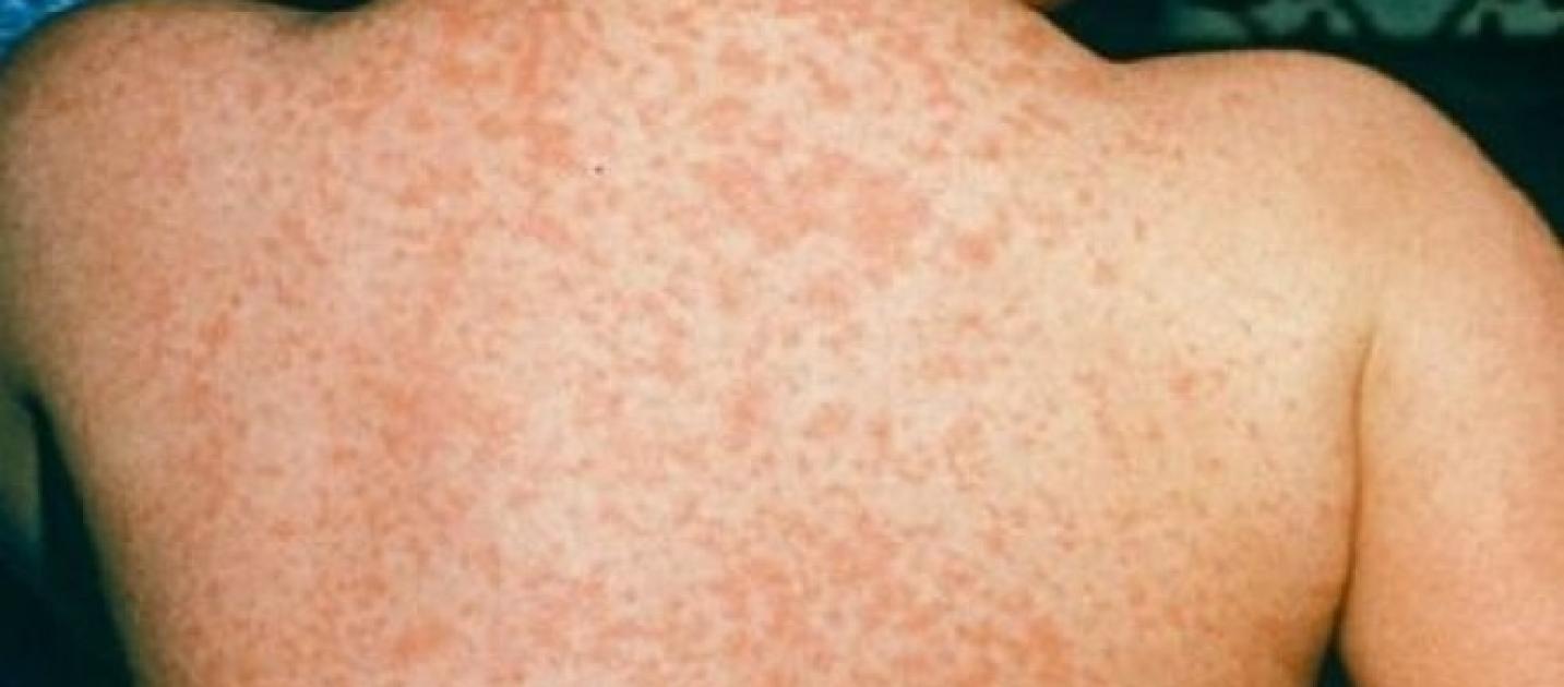 Una delle malattie più pericolose al mondo è tuttora contagiosa in Italia