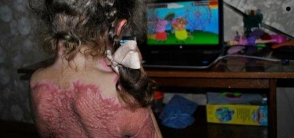 Jogo online induz crianças a sofrerem queimaduras.