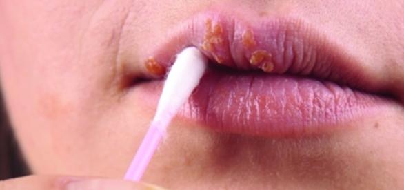 Sexo oral transmite supergonorreia e outras doenças (Foto: Reprodução)